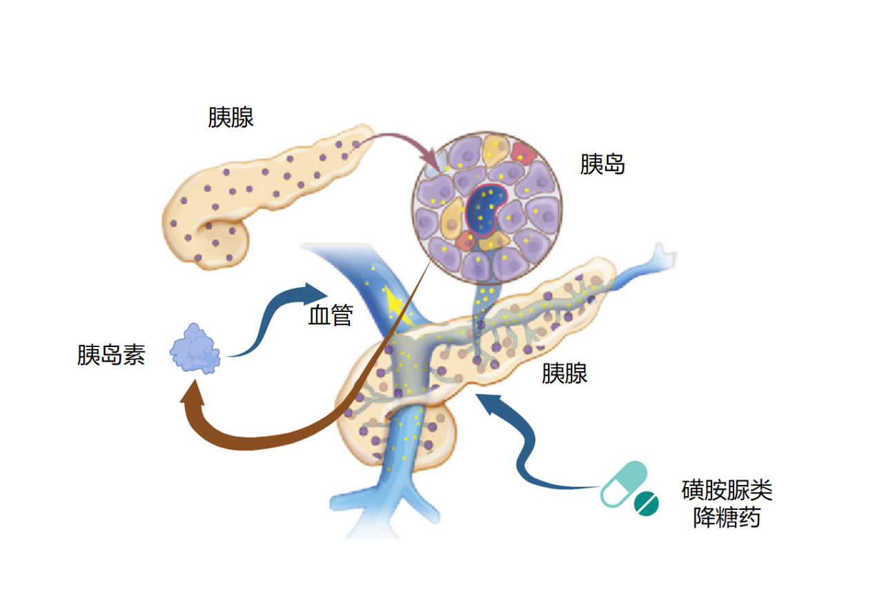 磺酰脲類降糖藥用藥小常識